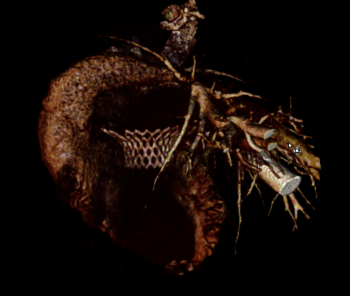 Kieler Herzklappentechnologie erhält EU-Zulassung