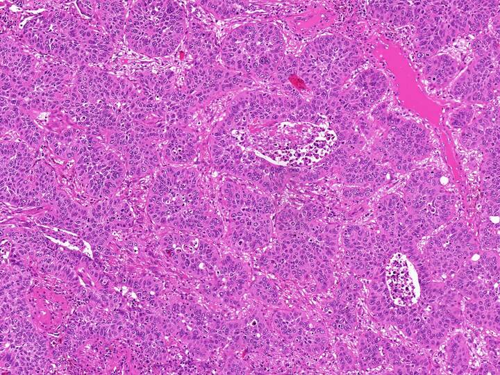 Maschinelles Lernen verbessert Diagnostik bei Krebs-Patienten